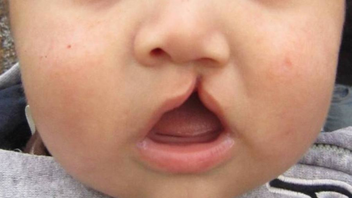 Câmara avalia política pública sobre fissura labiopalatina