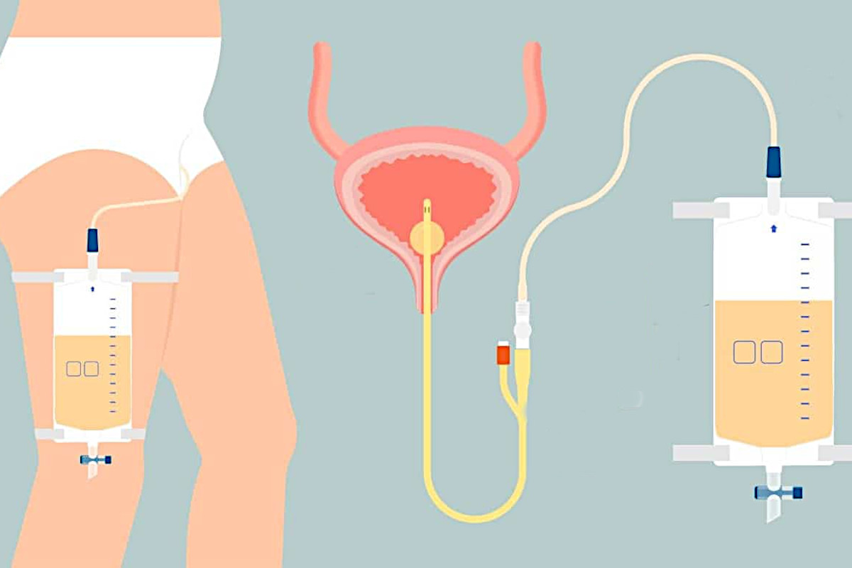 Câmara de Curitiba discute política de saúde para cateterismo vesical