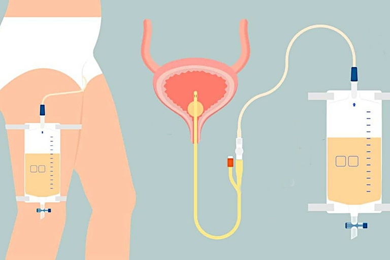 Câmara de Curitiba discute política de saúde para cateterismo vesical