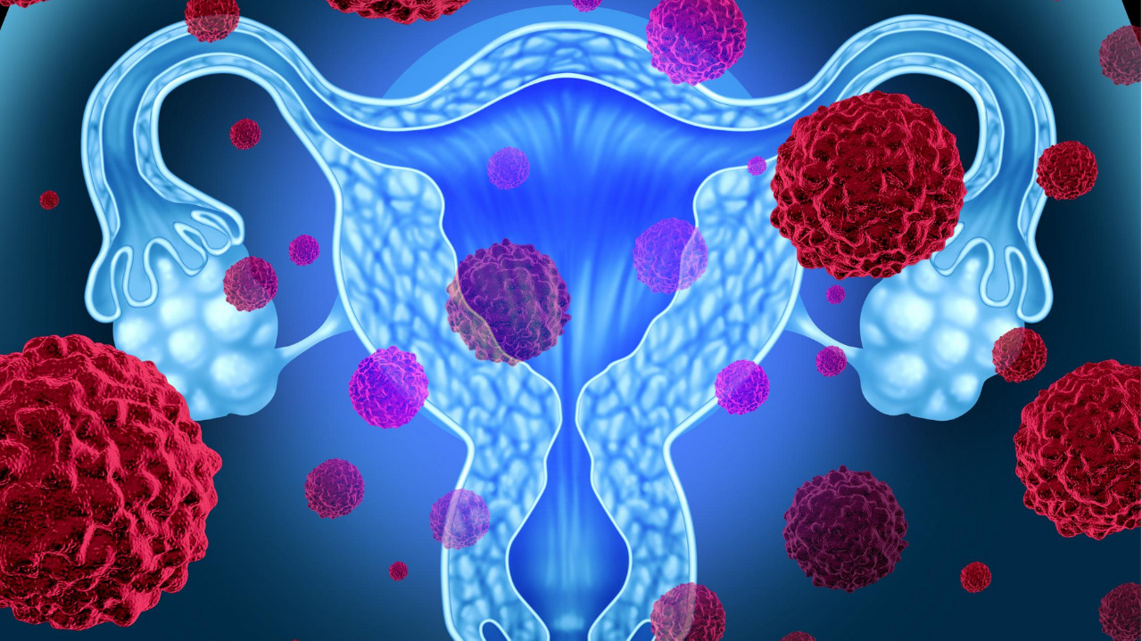 Política de Prevenção e Combate ao  Câncer de Ovário apresentada à CMC