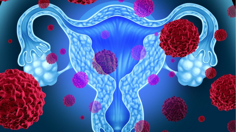 Política de Prevenção e Combate ao  Câncer de Ovário apresentada à CMC